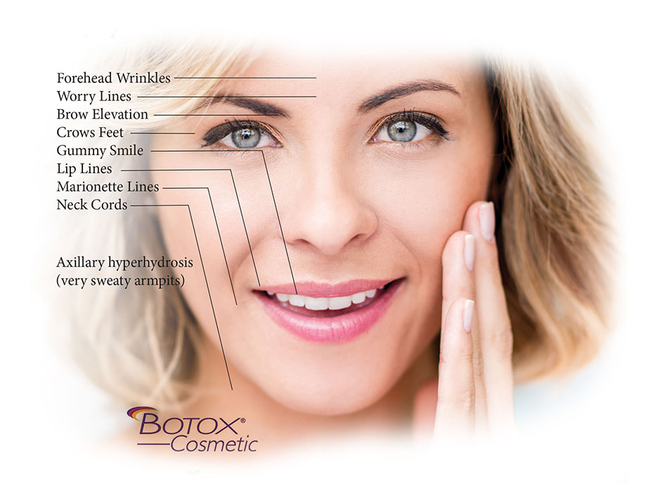 Photo for Botox Cosmetic featuring mode's face with captions 
